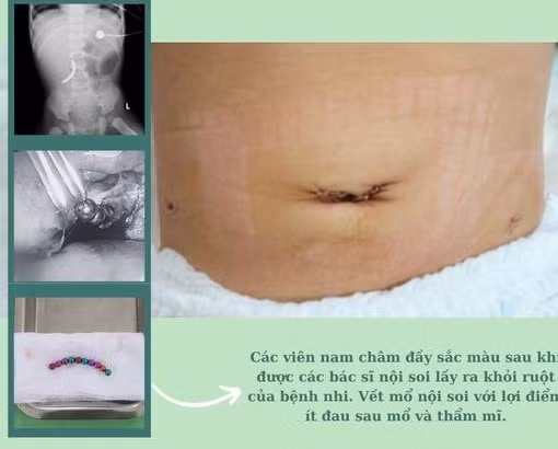 2,5 giờ nội soi lấy 10 cục nam châm khiến bé trai 18 tuổi thủng ruột ảnh 1
