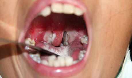 Lớp màng trắng trong cổ họng người bệnh bạch hầu - Ảnh minh họa