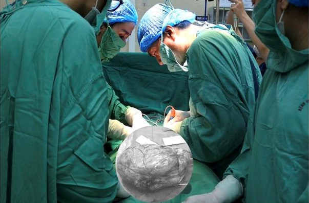 Ca phẫu thuật bóc nhân xơ tử cung kích thước lớn cho bệnh nhân - Ảnh BSCC