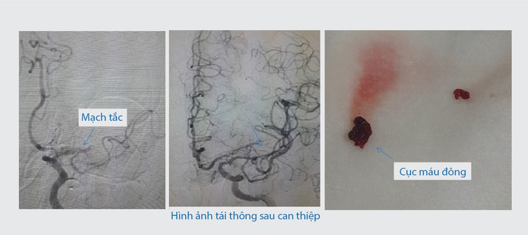 Hình ảnh can thiệp mạch -Ảnh BVCC