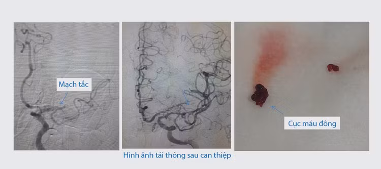 Hình ảnh can thiệp mạch -Ảnh BVCC