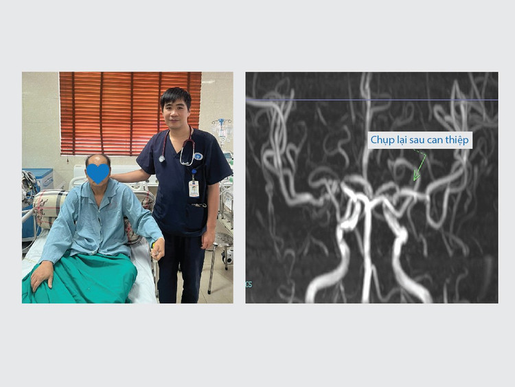 Hình ảnh mạch não chụp lại sau can thiệp 03 ngày, vị trí tắc mạch đã được lưu thông hoàn toàn - Ảnh BVCC