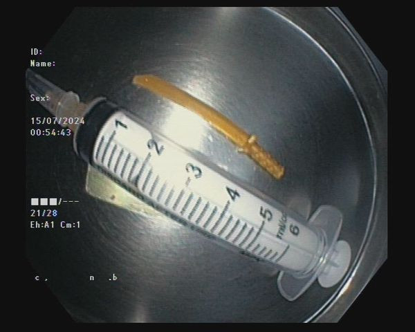 Thanh kiếm nhựa được lấy ra từ dạ dày bệnh nhân - Ảnh BVCC
