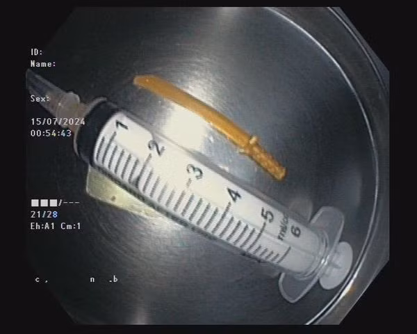 Thanh kiếm nhựa được lấy ra từ dạ dày bệnh nhân - Ảnh BVCC