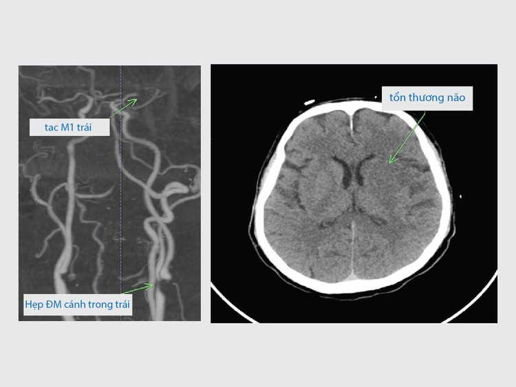 Phim chụp hẹp động mạch cảnh trong bên trái và tắc động mạch não giữa trái của người bệnh lúc mới vào viện