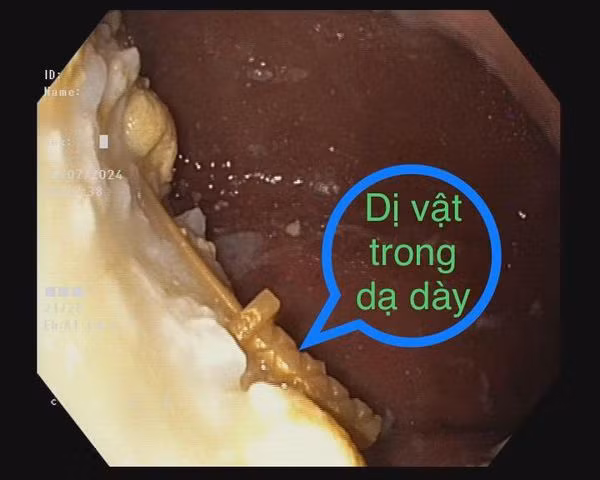 Lấy dị vật trong dạ dày trẻ 33 tháng - Ảnh BVCC
