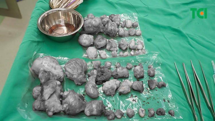 Hy hữu: Bóc 60 u xơ tử cung buồng trứng cho người bệnh ngoại quốc ảnh 2