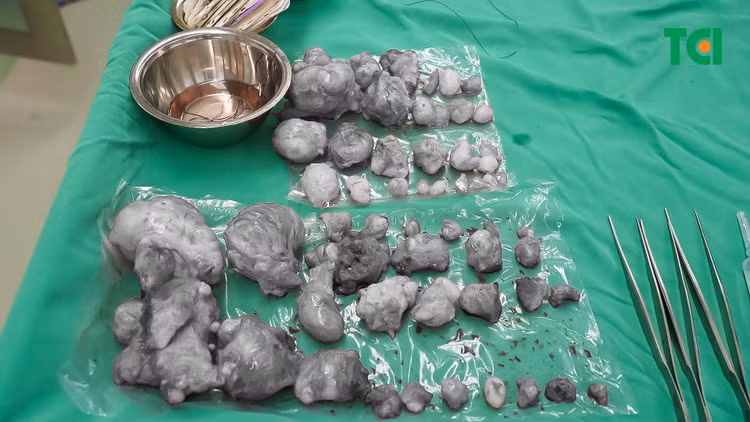 Hy hữu: Bóc 60 u xơ tử cung buồng trứng cho người bệnh ngoại quốc ảnh 2