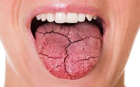 Bài thuốc độc đáo chữa chứng khô miệng vào ban đêm - Ảnh BVCC