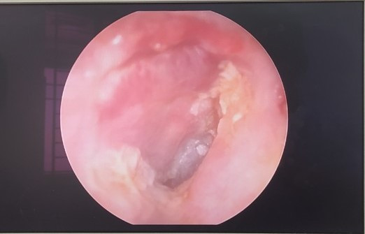 Màng nhĩ của người bệnh liền tốt sau 2 tuần phẫu thuật.