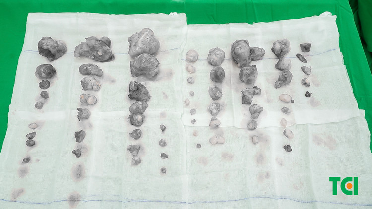 Hy hữu: Bóc 60 u xơ tử cung buồng trứng cho người bệnh ngoại quốc ảnh 3