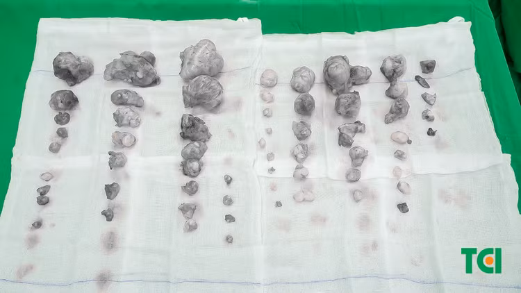 Hy hữu: Bóc 60 u xơ tử cung buồng trứng cho người bệnh ngoại quốc ảnh 3