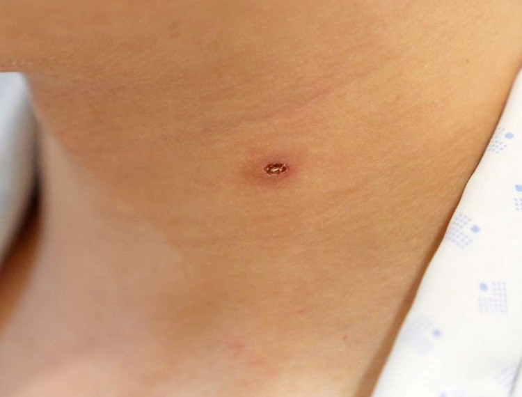 Bị ong vò vẽ đốt, người đàn ông 28 tuổi suy thận cấp ảnh 1