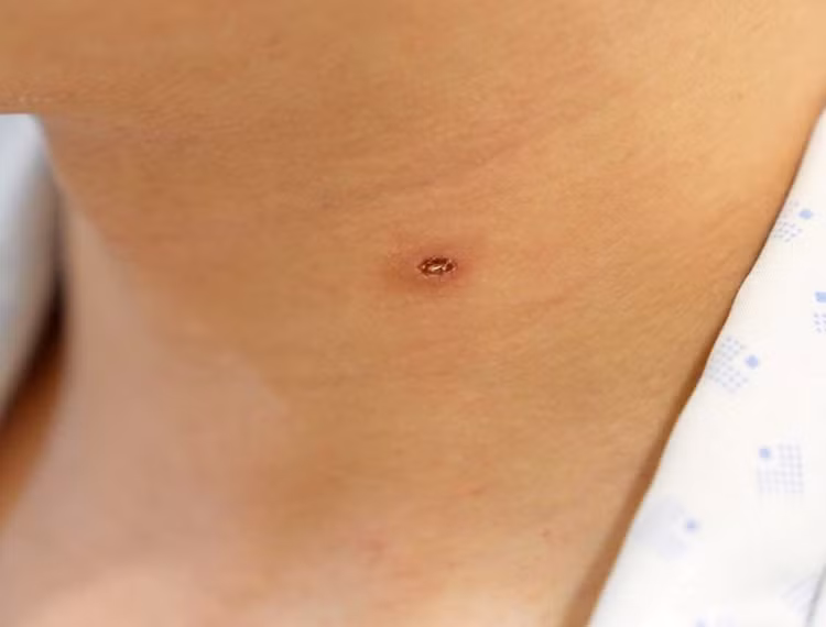 Bị ong vò vẽ đốt, người đàn ông 28 tuổi suy thận cấp ảnh 1