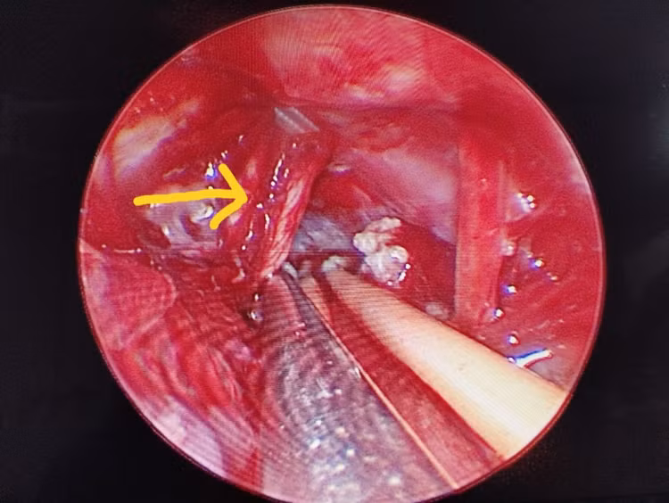Vi phẫu và nội soi cắt u góc tiểu não trị đau dây thần kinh V ảnh 3