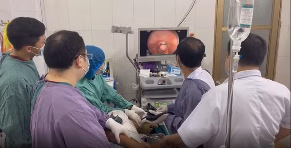 Can thiệp thắt tĩnh mạch thực quản cho bệnh nhân - Ảnh BVCC