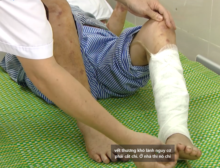 Nguy cơ phải cắt cụt chi vì vết thương khó lành - Ảnh BVCC