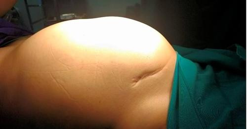 Phẫu thuật thành công khối u ác buồng trứng “khổng lồ” tại bệnh viện Hữu Nghị - ảnh BVCC