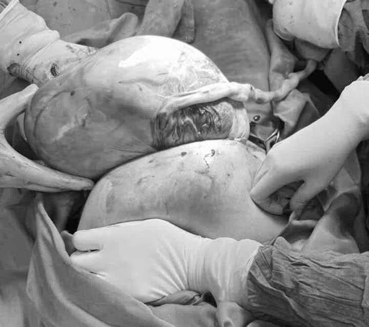 Thai nhi còn nguyên trong bọc ối - ảnh BVCC