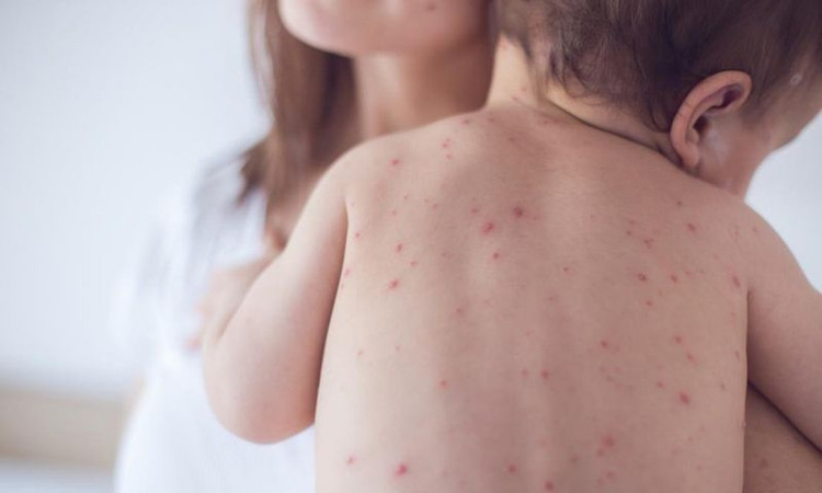 Hà Nội: Tăng cường giám sát bệnh Sởi - Ảnh minh họa Hà Nội: Tăng cường giám sát bệnh Sởi - Ảnh minh họa