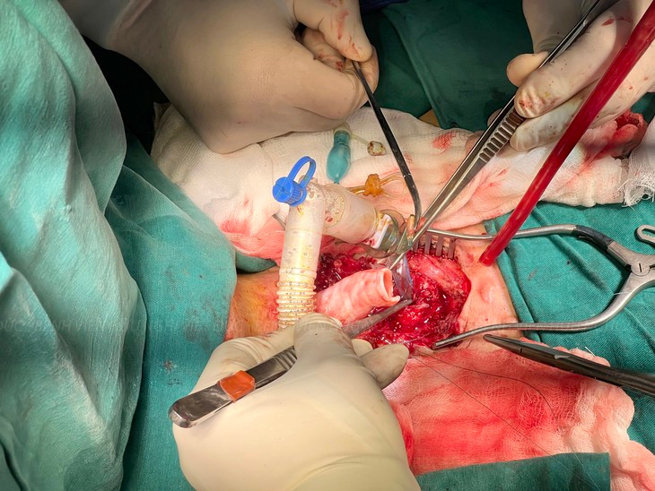 Lần đầu tiên Việt Nam ghép khí quản và phẫu thuật tạo hình thực quản hẹp hiếm gặp trong y văn - Ảnh BVCC