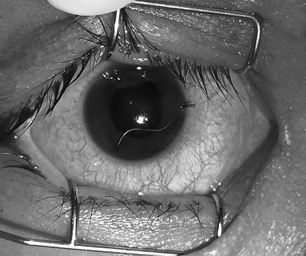 Người đàn ông nhập viện với đoạn dây thép xuyên nhãn cầu - Ảnh BVCC