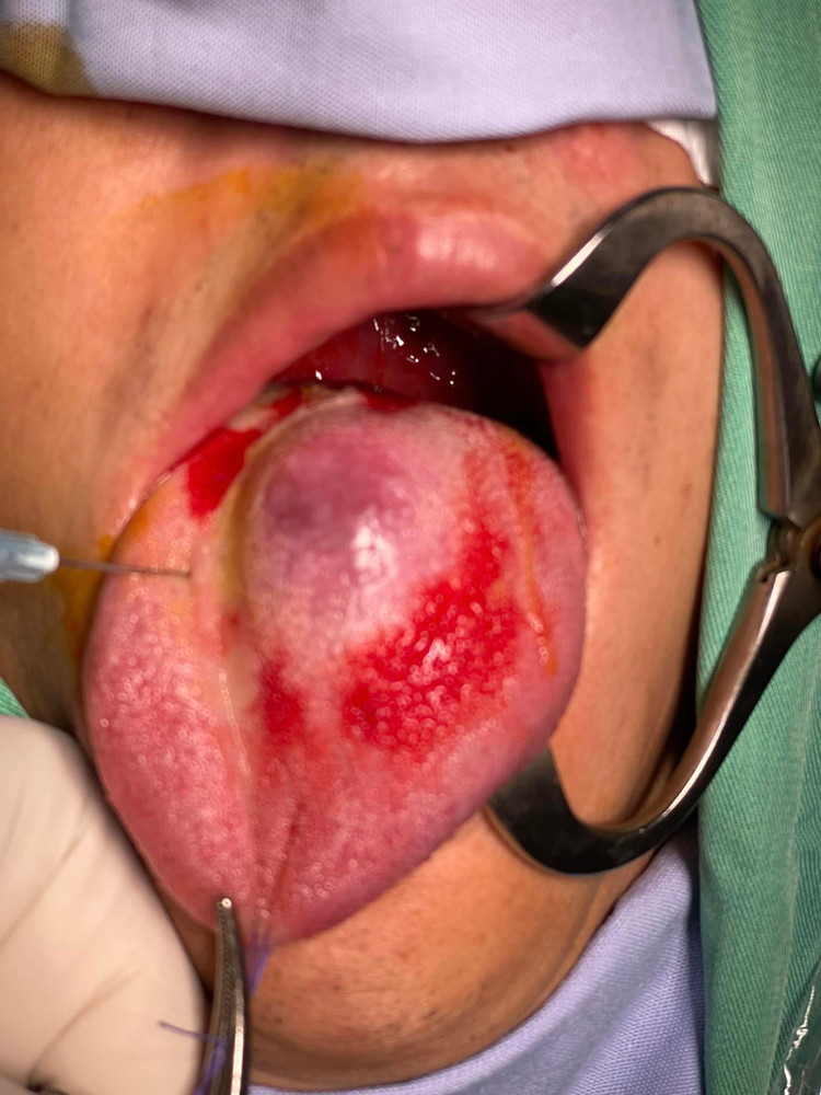 Phát hiện điều trị sớm có thể khỏi hoàn toàn - Ảnh BS Nguyễn Quốc Dũng Phát hiện điều trị sớm có thể khỏi hoàn toàn - Ảnh BS Nguyễn Quốc Dũng