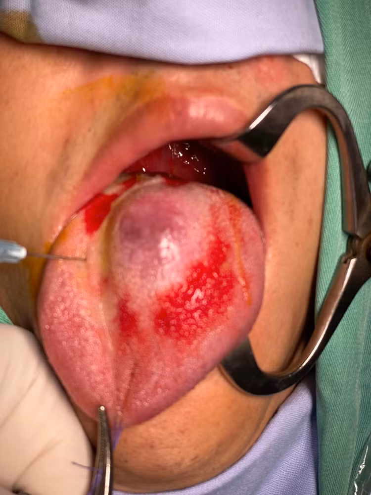 Phát hiện điều trị sớm có thể khỏi hoàn toàn - Ảnh BS Nguyễn Quốc Dũng