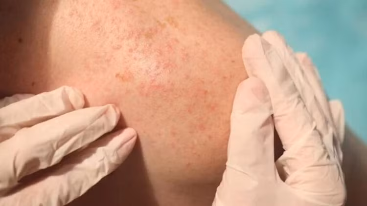 Biểu hiện của rôm sảy