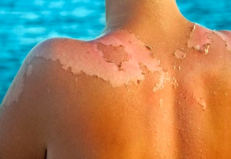 Cách phòng tránh các bệnh về da thường gặp khi nắng nóng ảnh 1