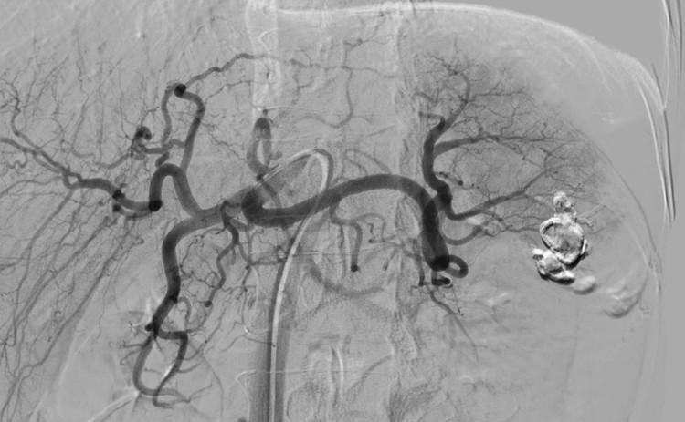 Nút mạch dưới hệ thống DSA cứu bệnh nhân sốc mất máy, vỡ lách độ IV ảnh 1 Nút mạch dưới hệ thống DSA cứu bệnh nhân sốc mất máy, vỡ lách độ IV ảnh 1