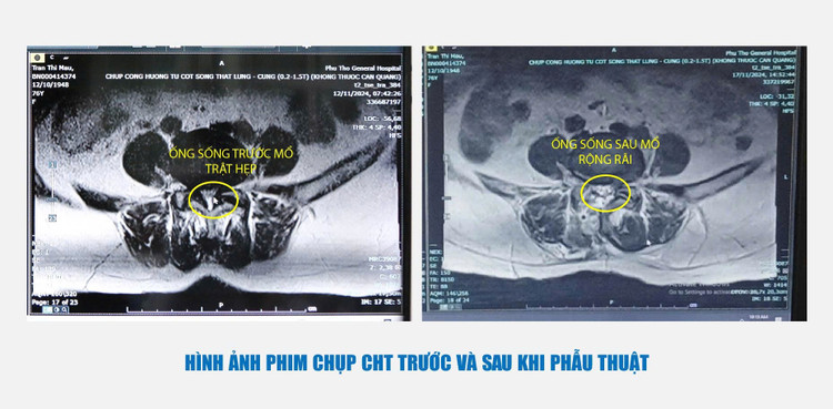 Hình ảnh phim chụp CHT trước và sau khi phẫu thuật - Ảnh BVCC