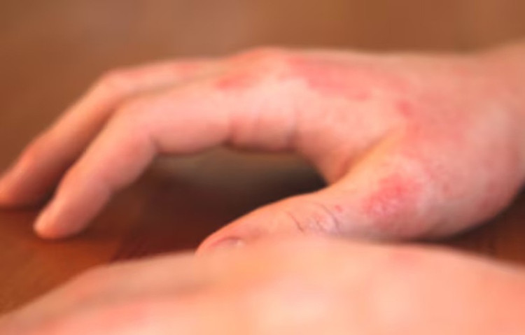 Ngoài việc gây khó chịu, bệnh chàm còn có thể ảnh hưởng tiêu cực đến sức khỏe tổng thể của bạn. (Ảnh: ITN) Ngoài việc gây khó chịu, bệnh chàm còn có thể ảnh hưởng tiêu cực đến sức khỏe tổng thể của bạn. (Ảnh: ITN)