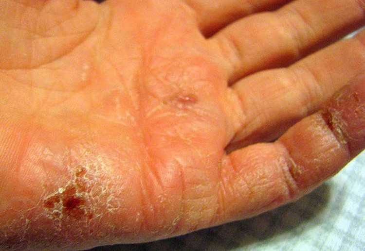 Nhiều người gặp phải tình trạng da nứt nẻ, khô ráp gây ngứa ngáy khó chịu, thậm chí là đau đớn. (Ảnh: ITN) Nhiều người gặp phải tình trạng da nứt nẻ, khô ráp gây ngứa ngáy khó chịu, thậm chí là đau đớn. (Ảnh: ITN)