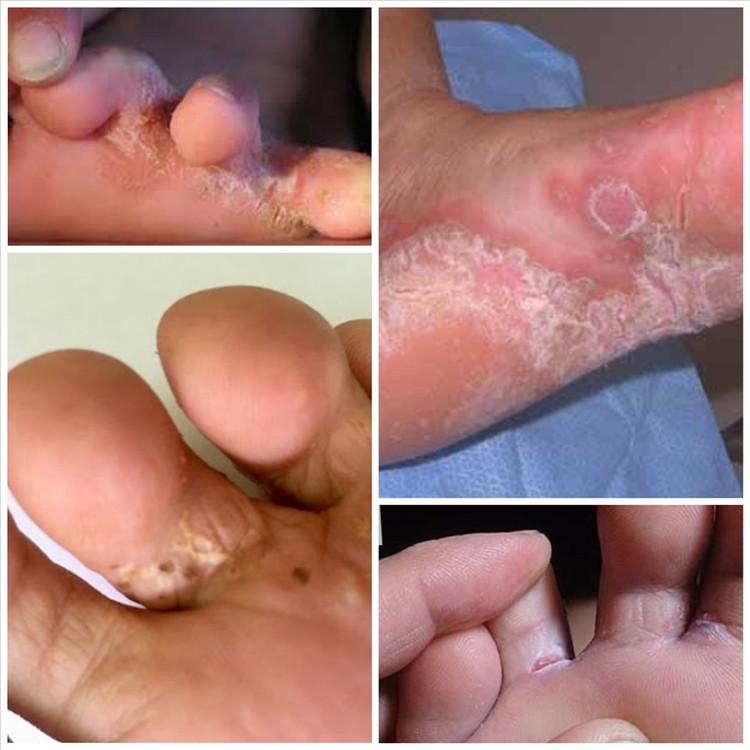 Bệnh ấu trùng di chuyển ở da (Cutaneous larval migrans – creeping eruption) do ấu trùng giun sán có trong nước lũ xâm nhập vào da.