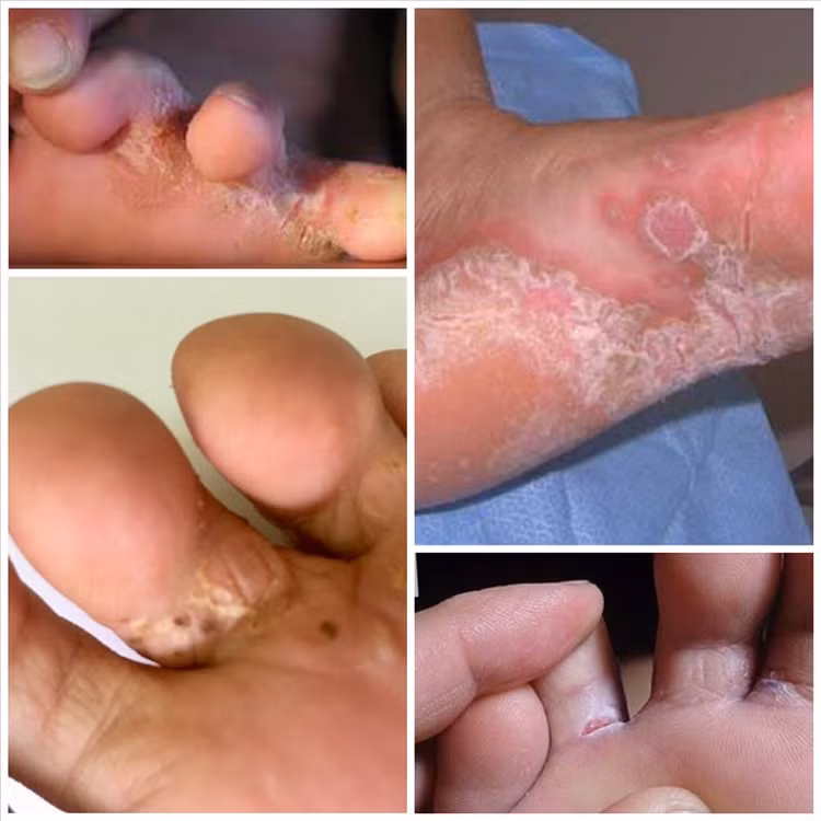 Bệnh ấu trùng di chuyển ở da (Cutaneous larval migrans – creeping eruption) do ấu trùng giun sán có trong nước lũ xâm nhập vào da.