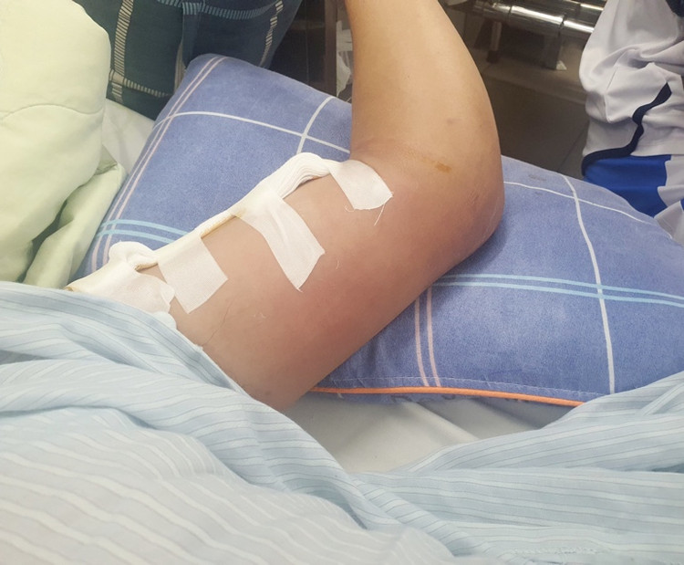 Bệnh nhân Whitmore bị sưng đau, áp xe tay trái, ổ vi khuẩn vào tận xương - Ảnh BVCC