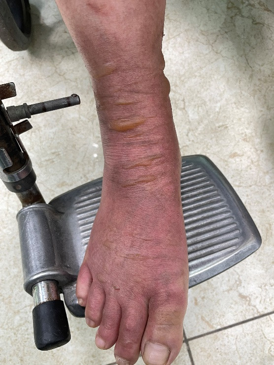 Bỏng độ 2 do nước sôi, xảy ra khi vấp chân vào vật dụng để sai vị trí trong lúc đun nấu (di dời vật dụng để tránh thiệt hại do ngập lụt). Bệnh nhân đến khám và điều trị tại Khoa Da liễu và Bỏng – Bệnh viện Bạch Mai)