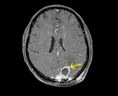 Bệnh nhân Whitmore bị ép xe não thuỳ chẩm đỉnh trái - Ảnh BVCC