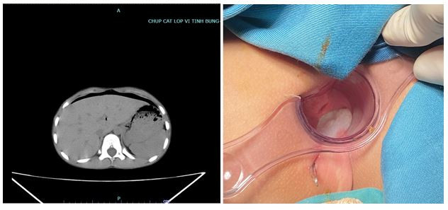 Hình ảnh khí tự do ổ bụng qua phim chụp CT và vết thương trực tràng của người bệnh