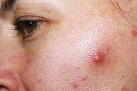 Bác sĩ da liễu mách cách phòng ngừa bệnh da mùa hè .