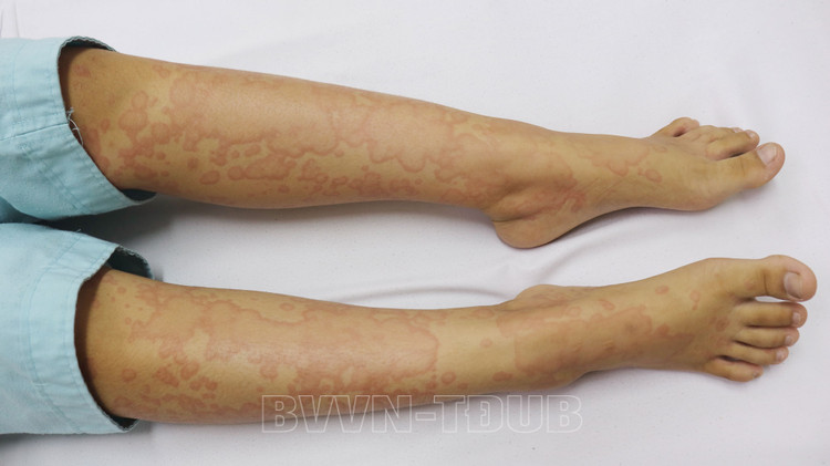 Ban đỏ của bệnh nhi khi vào viện - Ảnh BVCC