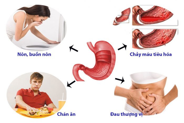 Biến chứng của trào ngược dạ dày thực quản - Ảnh minh họa