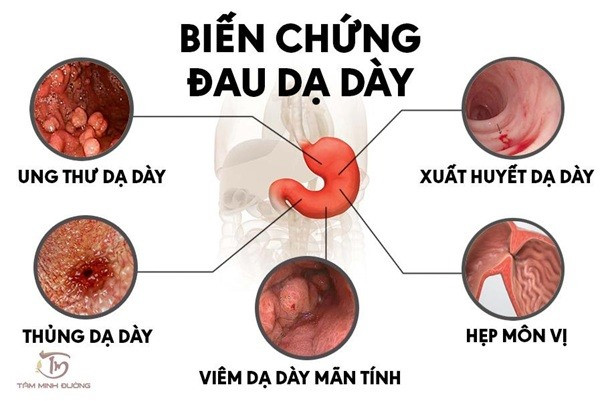 Các bệnh thường gặp về dạ dày ai cũng nên biết ảnh 1
