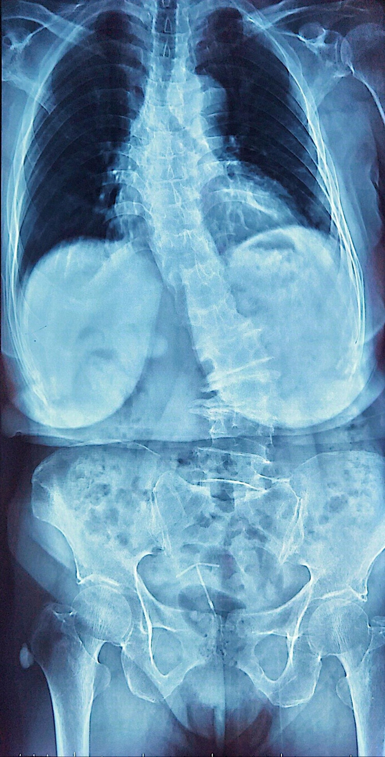 Hình ảnh loãng xương trên phim chụp - Ảnh BSCC