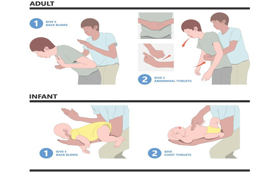 Bác sĩ hướng dẫn cách thực hiện thủ thuật Heimlich đúng tránh biến chứng - Ảnh BVCC