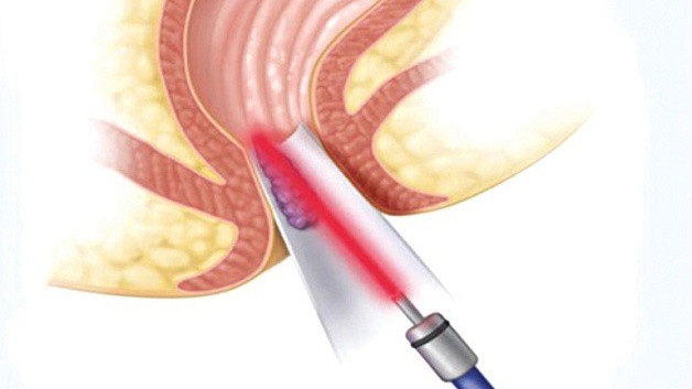 Phương pháp cắt trĩ bằng laser giúp người bệnh điều trị bệnh trĩ an toàn - Ảnh BVCC