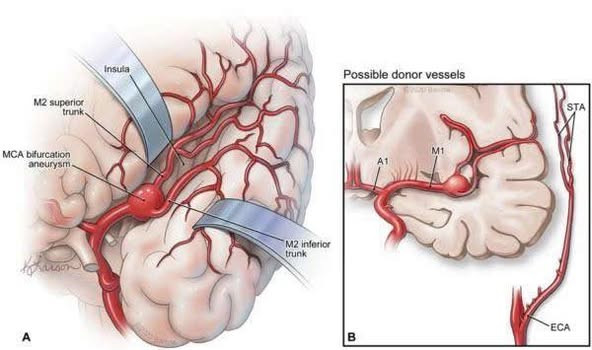 Phẫu thuật phức tạp cứu bệnh nhân phình mạch não lớn - Ảnh BVCC