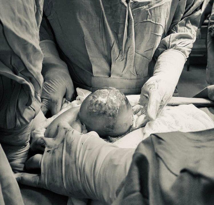 Ca mổ lấy thai khẩn cấp cứu sản phụ và thai nhi - Ảnh BVCC