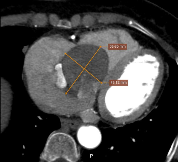 Khối u khổng lồ qua phim chụp CT - Ảnh BVCC